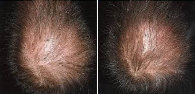 How Hair Loss Treatment Works? - Minoxidil - REGAINE® UK