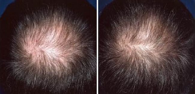 How Hair Loss Treatment Works? | Minoxidil | REGAINE® UK